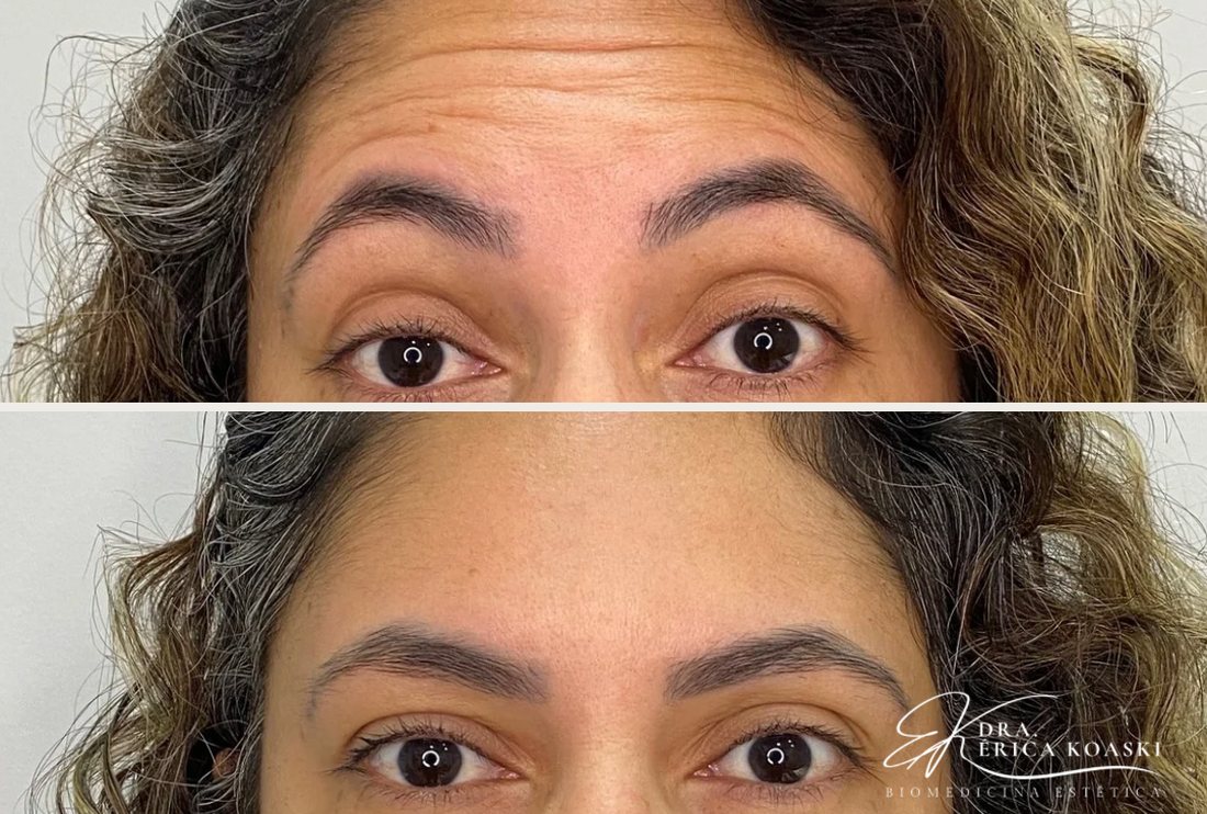 Antes e depois de aplicação de toxina botulínica na testa, realizada pela Dra. Érica Koaski.