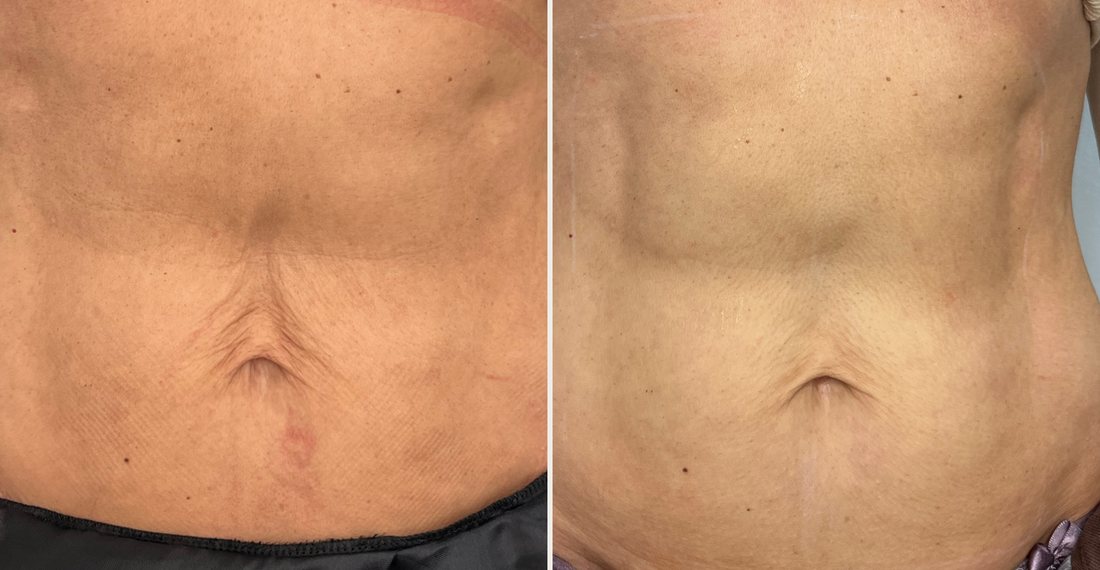 Antes e depois de tratamento de flacidez abdominal realizado pela Dra. Érica Koaski.