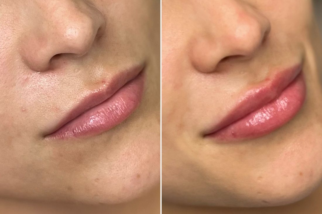 Antes e depois de preenchimento labial realizado pela Dra. Érica Koaski.