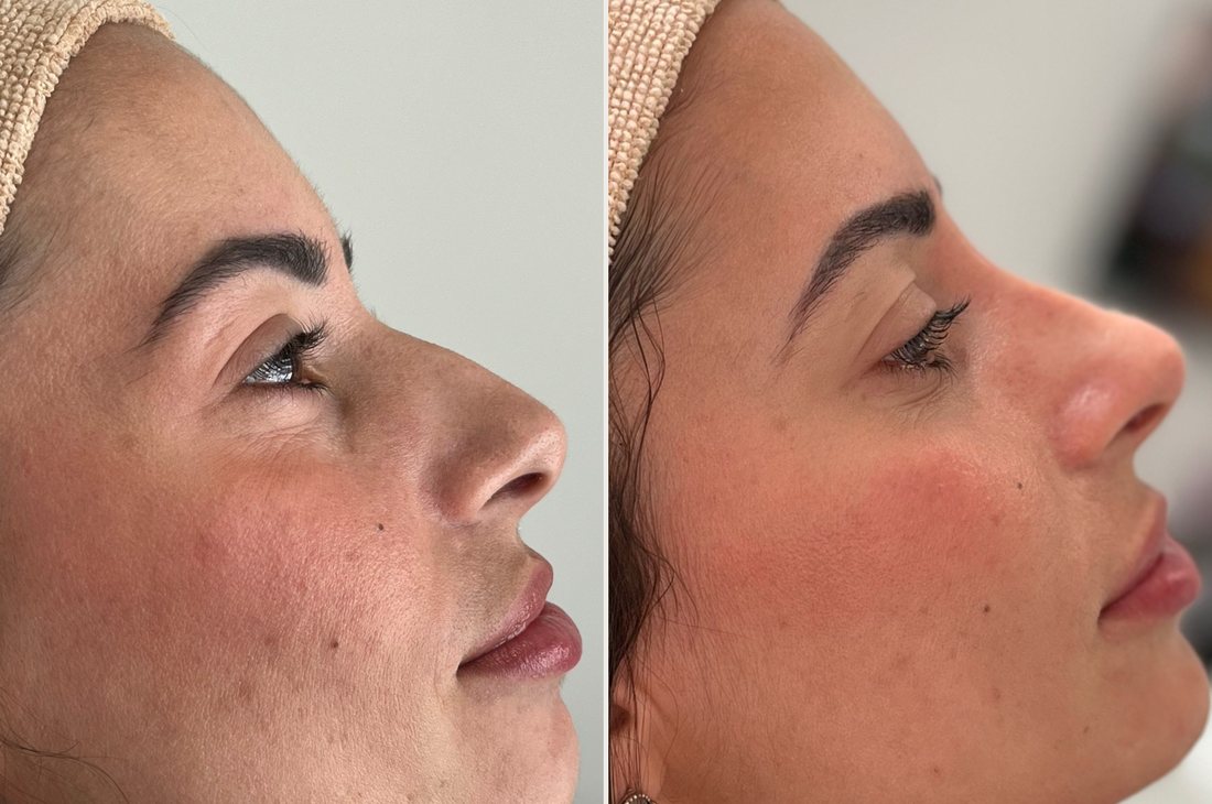 Antes e depois de rinomodelação realizada pela Dra. Érica Koaski.