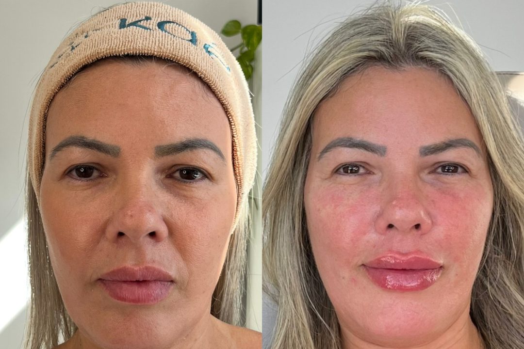 Antes e depois de harmonização facial realizada pela Dra. Érica Koaski.